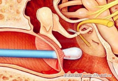 挖耳朵的小知识。看完专家说明，再也不敢乱挖了！