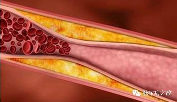 关于血脂异常的9件事