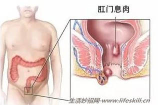 莫把息肉当痔疮！