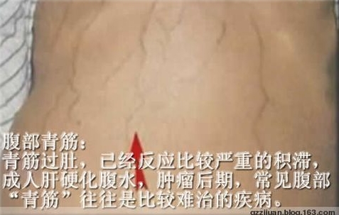 人体体表“青筋”凸起意味着什么?