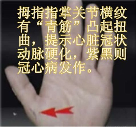 人体体表“青筋”凸起意味着什么?